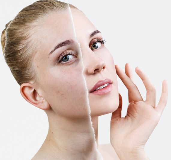 acne scar treatment