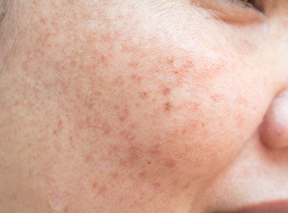 freckle removal