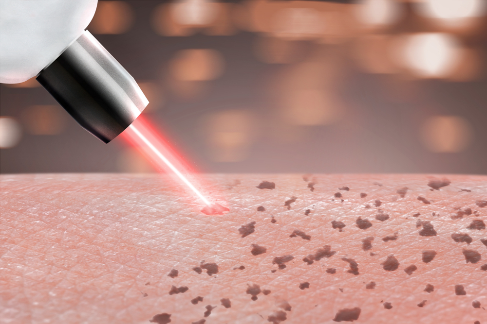 Tattoo Time Machine Laser Clinic 8 b639351ec6