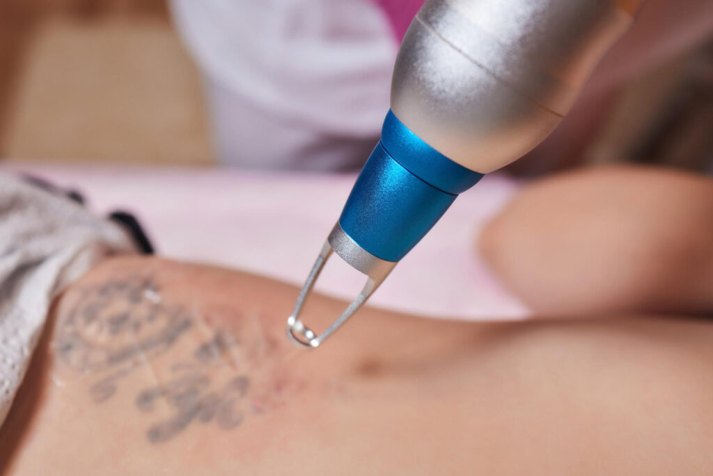 How it works: pico way laser tattoo removal in progress